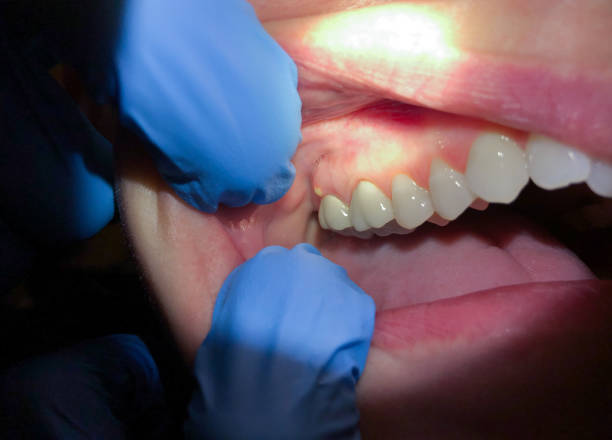 Best Emergency Treatment for Dental Infections or Abscesses in Hudson, IA